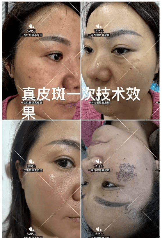 真皮斑可以祛除吗 真皮斑是什么原因引起的