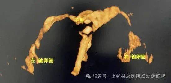 谢永玉团队完成全县首例探查精子和卵子的"鹊桥之路"4d子宫输卵管超声