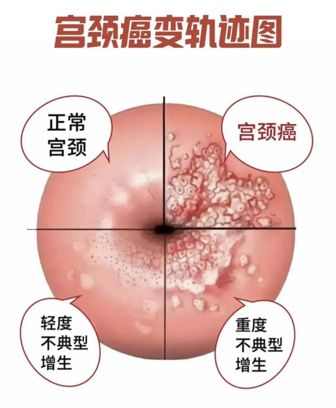 身体这三处出现疙瘩可能是宫颈癌预警