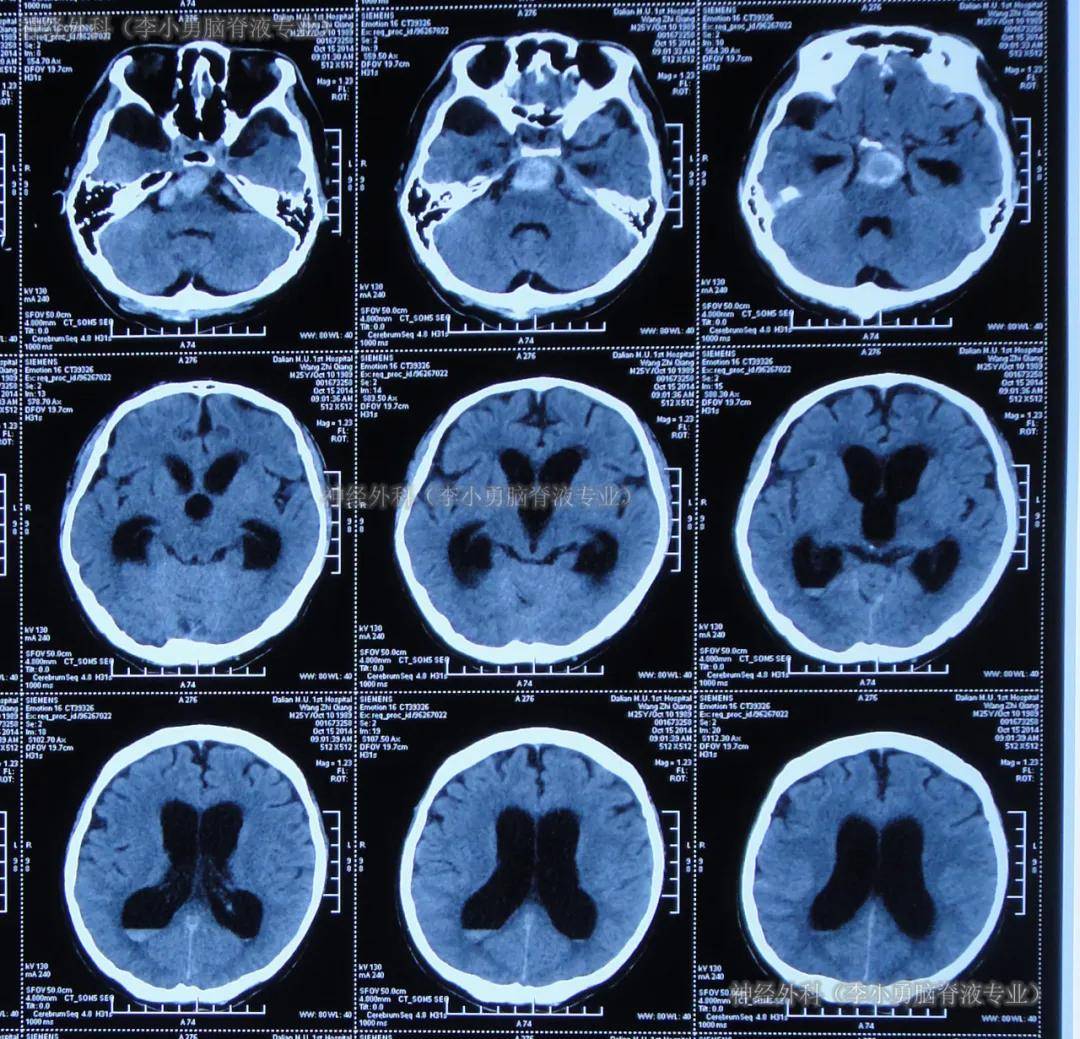 脑基底动脉瘤术后仍脑积水且颅内感染严重,现意识不清,反应慢,在李小