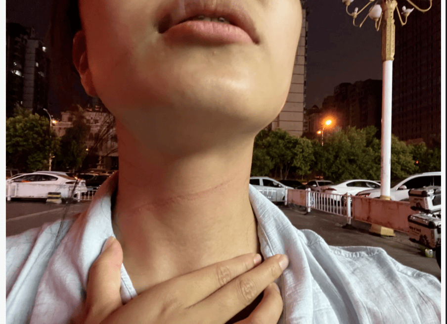 河北女半夜骑电动车被警戒线勒伤
，当地回应：其时正施工
，已获体谅