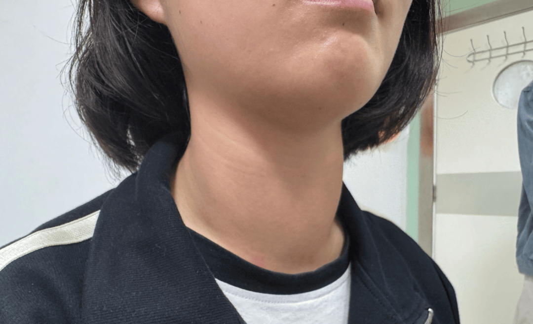 甲亢不可小觑：从认识、治疗到安全防控，一文读懂