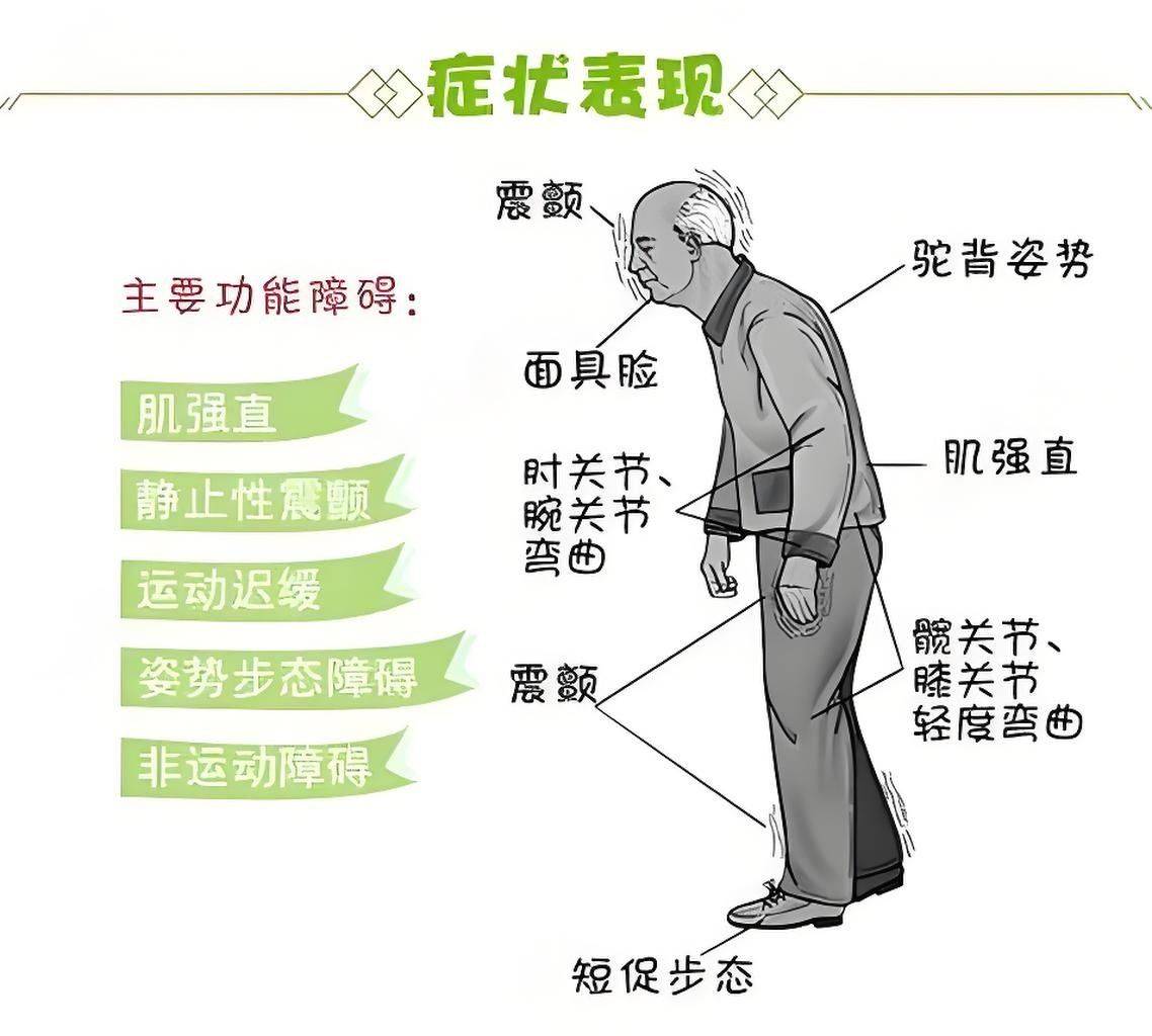 患者关注点:帕金森肢体僵硬会影响寿命吗?