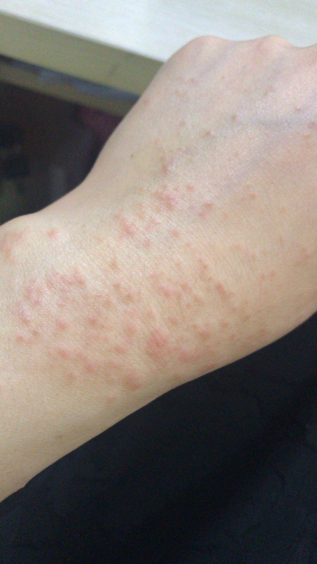 被湿疹缠了 5 年,胳膊肘,小腿内侧反复泛红脱皮,痒起来能把自己抓出血