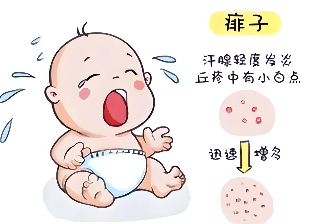 一到夏季为什么会长痱子,应该怎么预防?