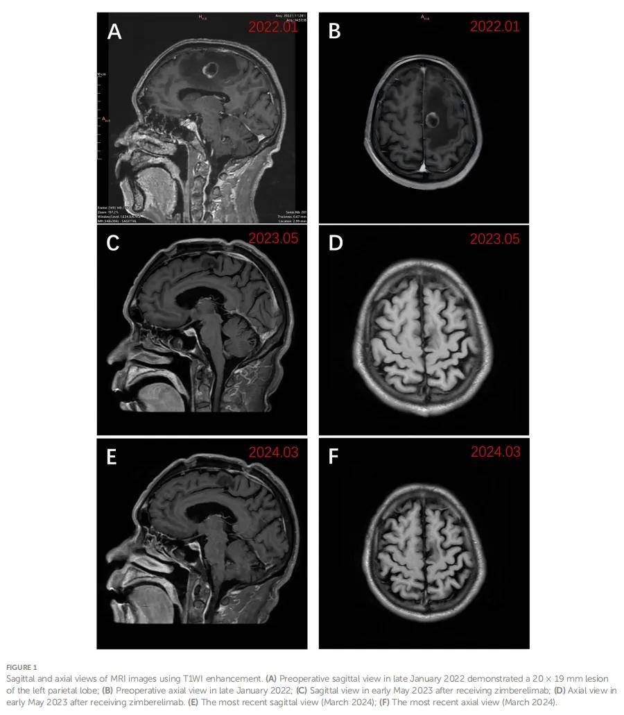 pd-l1高表达非小细胞肺癌脑转移患者获益赛帕利单抗,颅内无复发生存期