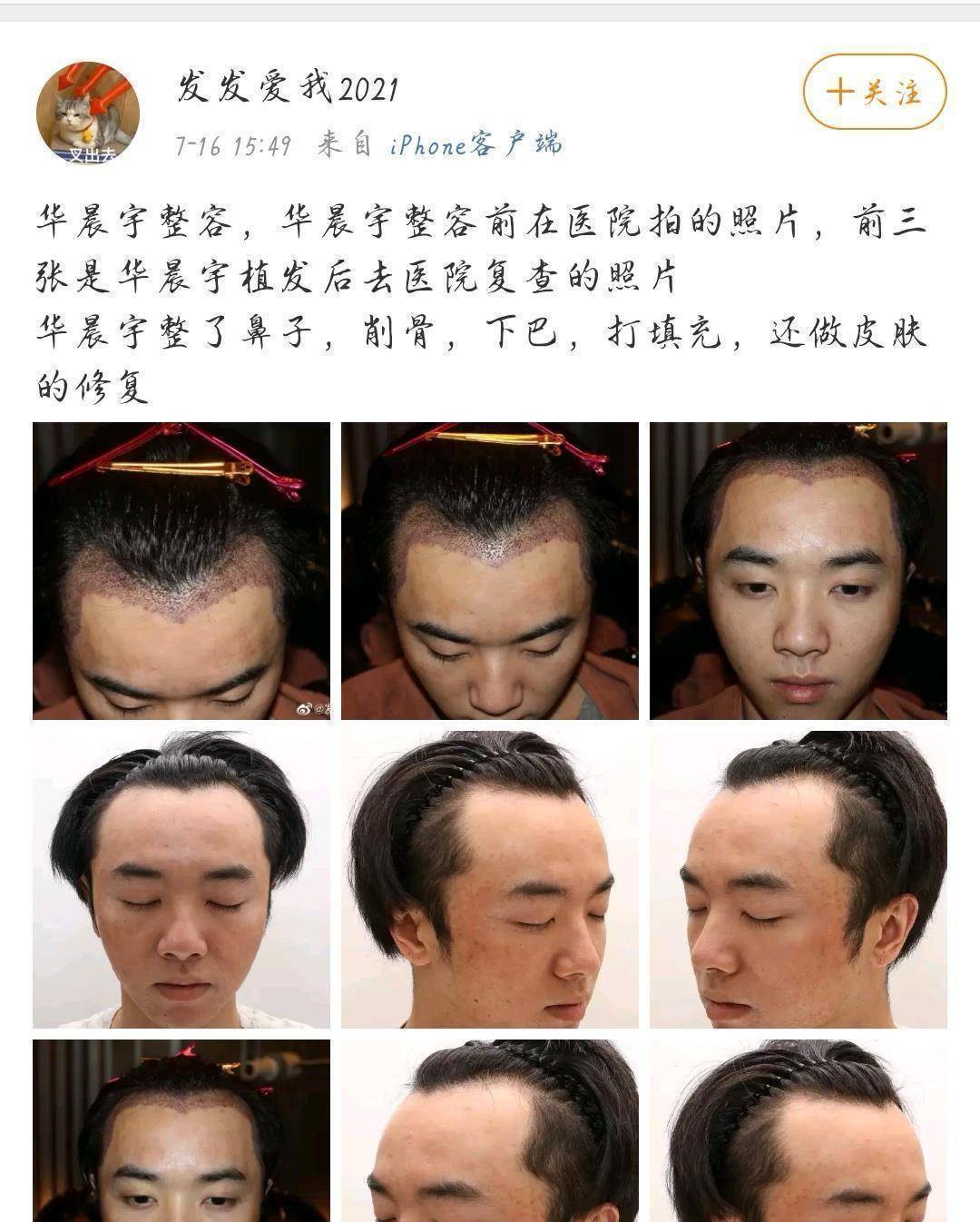 而甚至还有自称是华晨宇前女友的在网上爆出华晨宇整容植发的照片