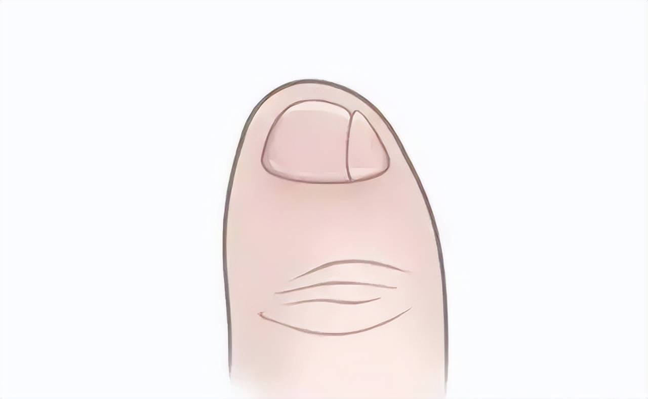 如果你发现自己小脚趾上的指甲有两片,不妨看看你的家族中是否也有人