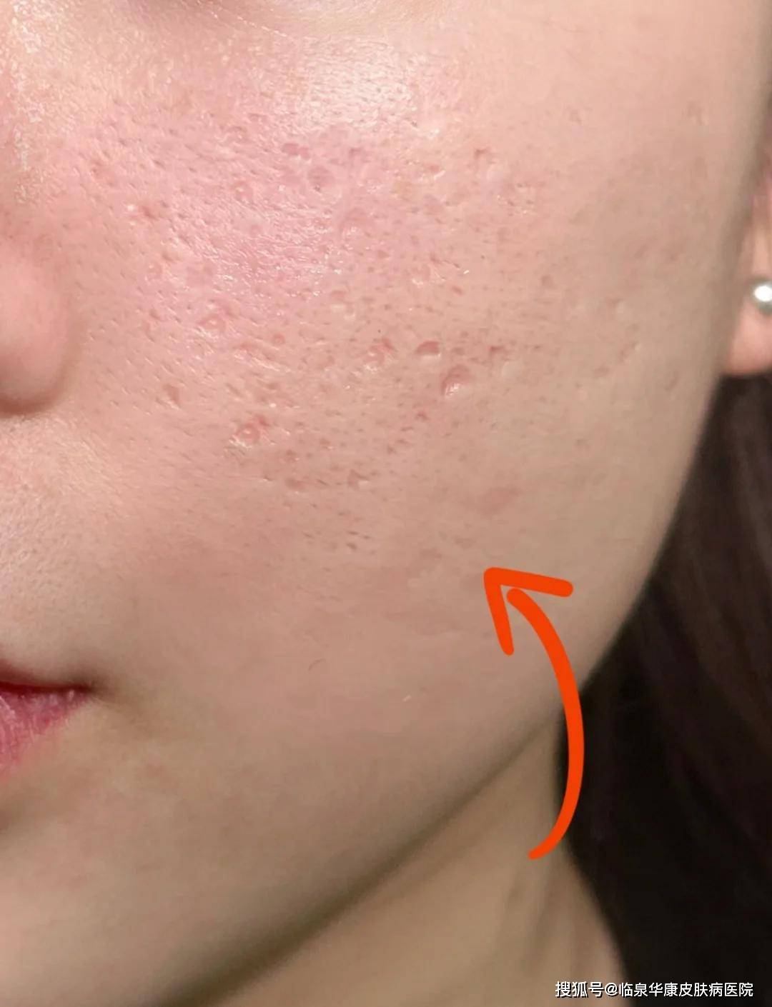 月球表面般的痘坑毁颜值?科学修复指南拯救你的光滑肌肤