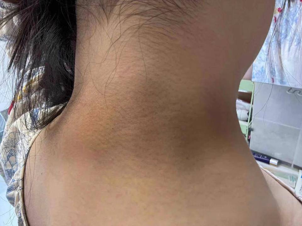 小孩的鸡不长怎么办呢？医生：脂肪包住！