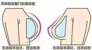 如何分辨真胸和假胸？隆的和真的一眼分辨