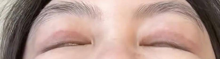 做了手术闭眼困难 瑞格医美楚院长的术后案例被曝修图后发布(图3)