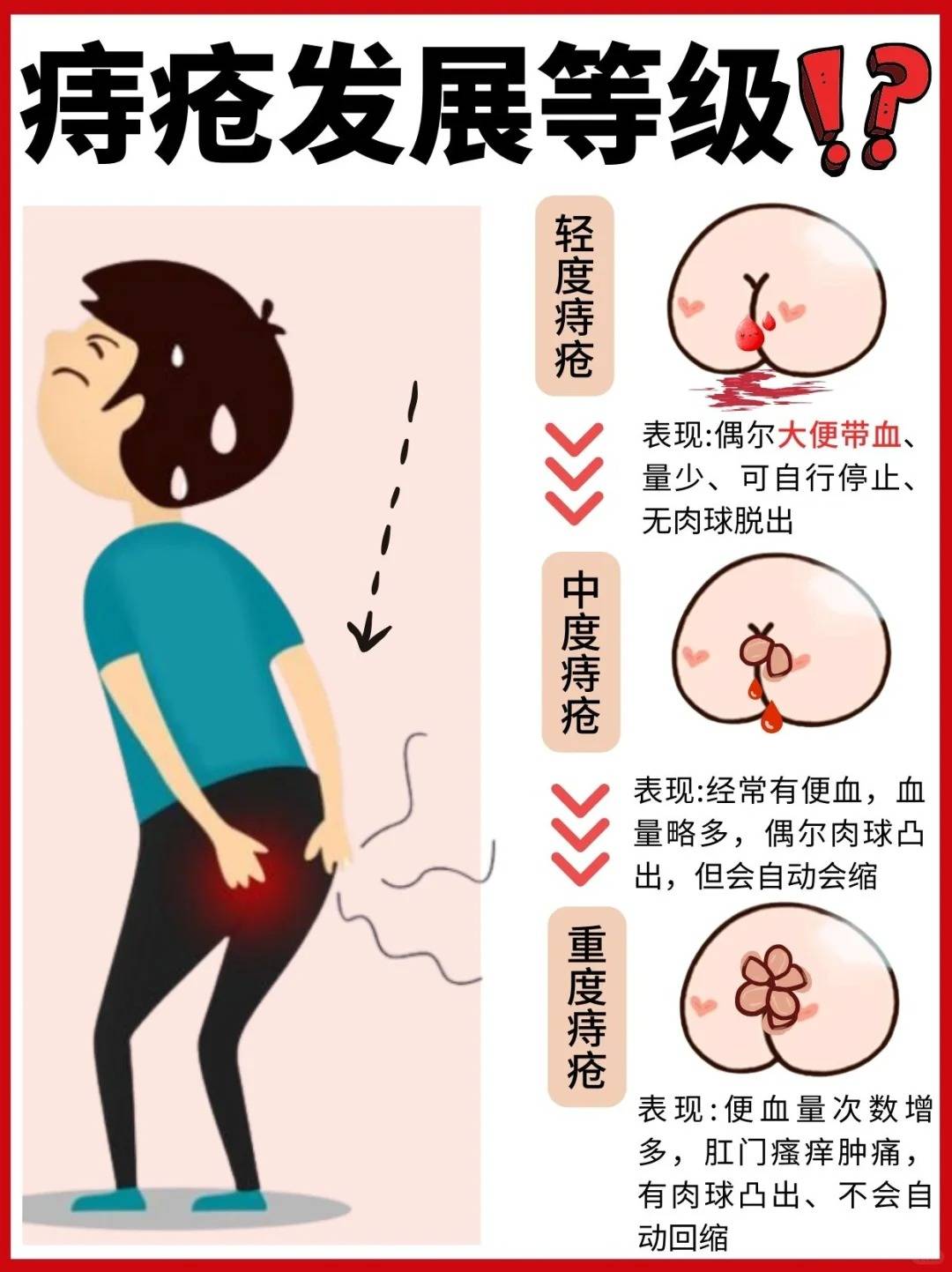 十人九痔?痔疮肉球到底是什么!