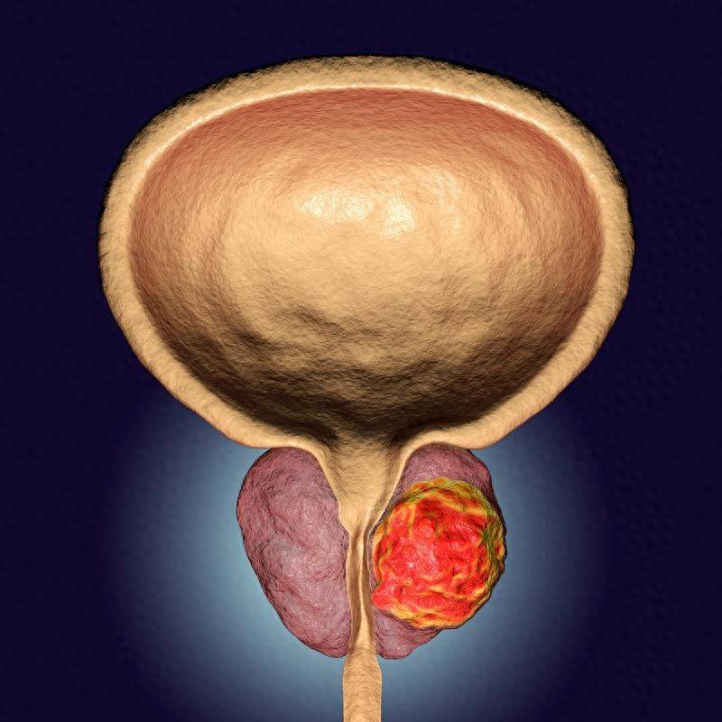 原创            50岁后预防前列腺癌，这些信号别误判为普通增生，做好早期筛查