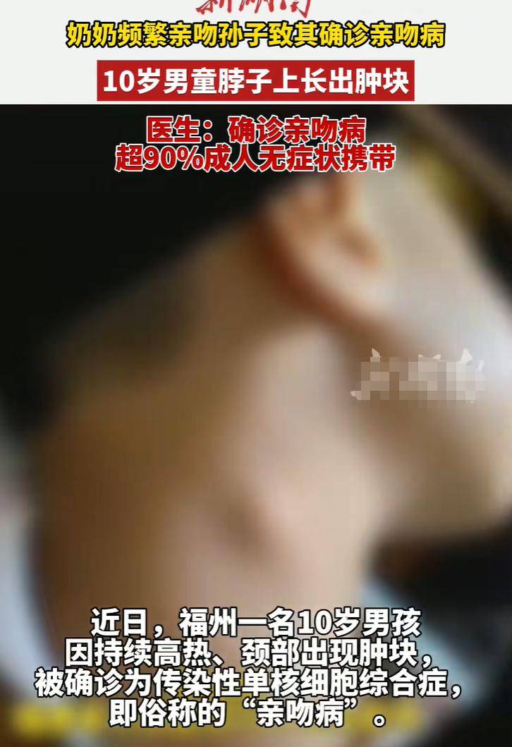奶奶频繁亲吻孩子致其确诊亲吻病,导致10岁男孩脖子长肿块