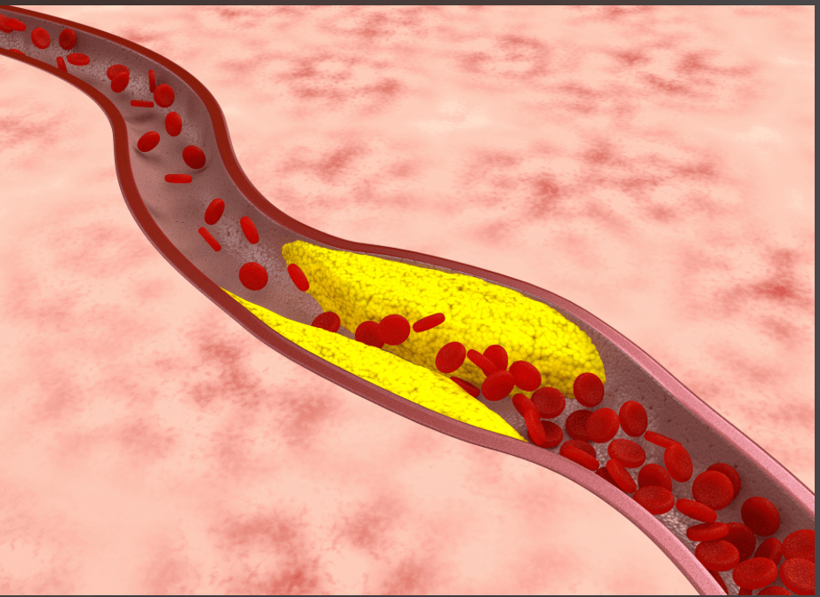 动脉硬化是病吗？只是身体求救信号！