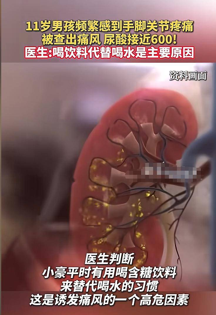 孩子不爱喝水有多危险？6岁长结石,11岁痛风,12岁脑梗