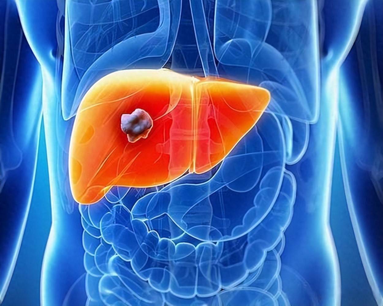 原创            肝癌可防、可筛、可治！早期发现是关键，5类信号别忽视
