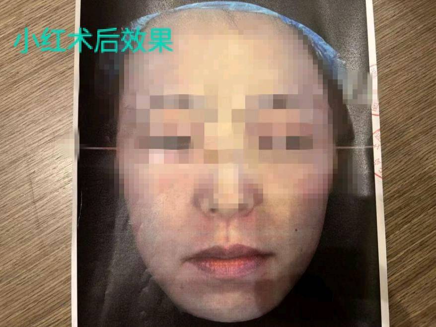 女子称6999超声刀没效果 西安高一生医疗美容被指病历代签?(图4) get?code=Nzg4NzFlMjExZmY5NzBkYWYzNDQ1NGM0MGQ5MTM5MDcsMTc3Mzg4NTQ4NzI4MA==