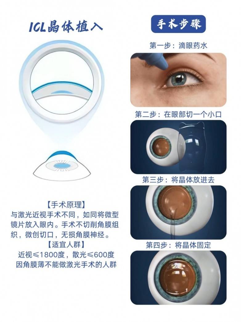 高中教师摘镜记：严谨考量后，他选择了ICL晶体植入术(图3)