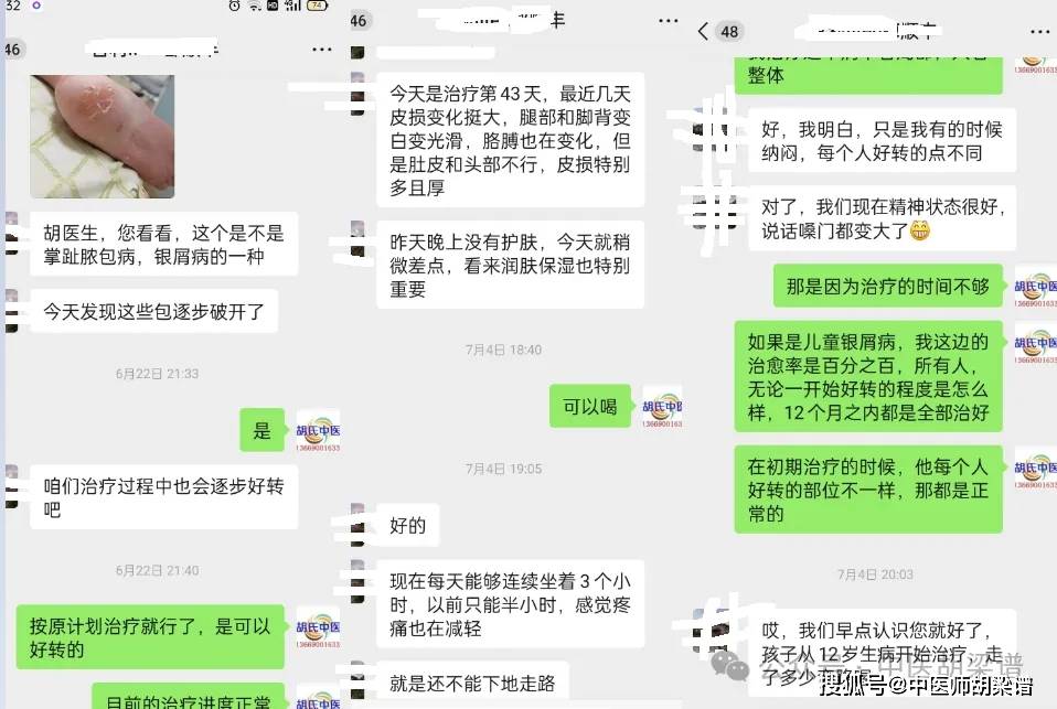 中医专利为什么要用祛邪散风法而非清热解毒法治疗银屑病