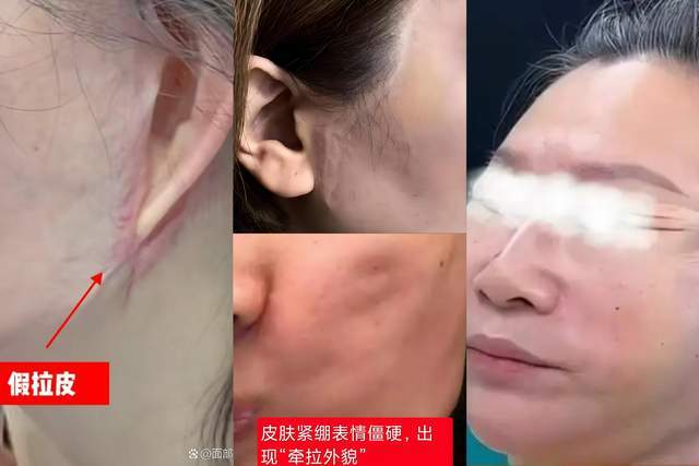 拉皮修复需要重新做切口吗？疤痕会不会更长？魏广运解析
