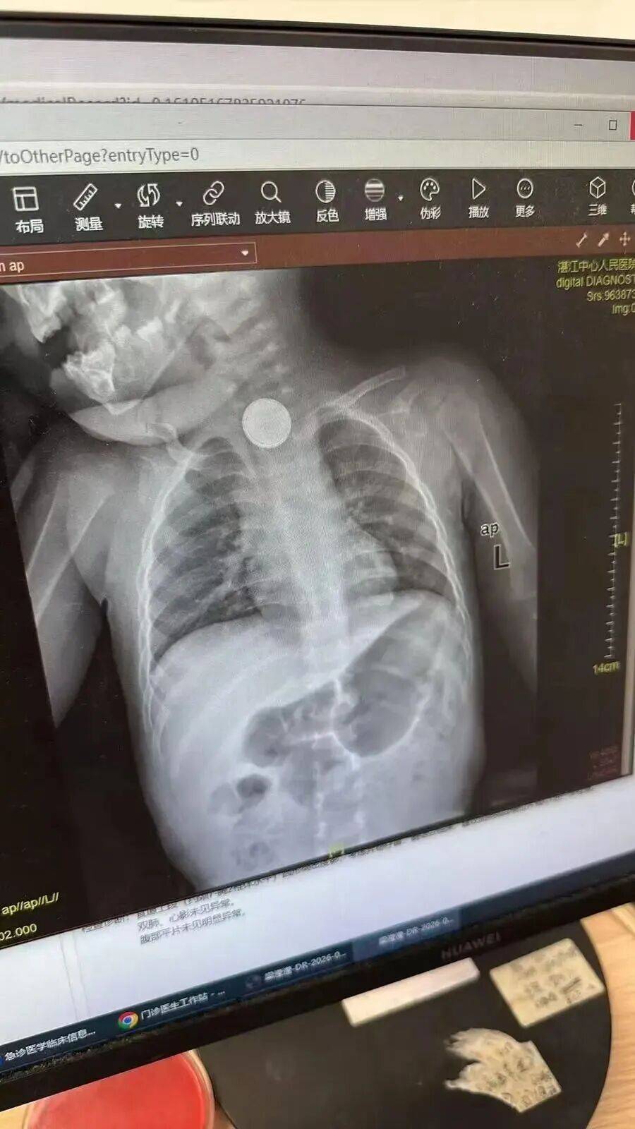 广东一女婴误吞纽扣电池26小时才被送医,食道被腐蚀、严重灼伤,医生提醒