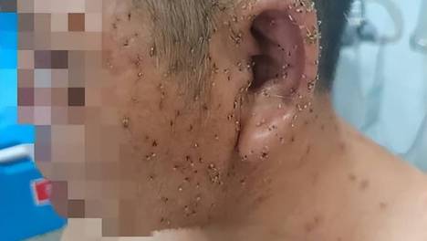 男子散步遭蜂群围攻，全身残留近千根毒刺，大量蜂毒入血致多脏器受损；医院三人“拔刺小组”耗时3小时剥离全部毒刺抢回生命，医生提醒