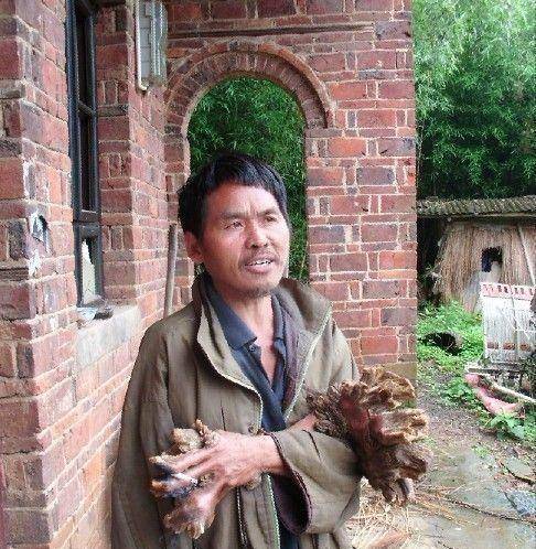 湖南"树人"刘忠文:四肢与树皮无异,采用偏方导致双手"开花"