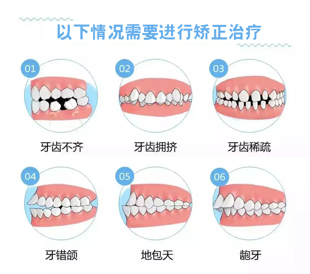 哪些牙齿类型要矫正?