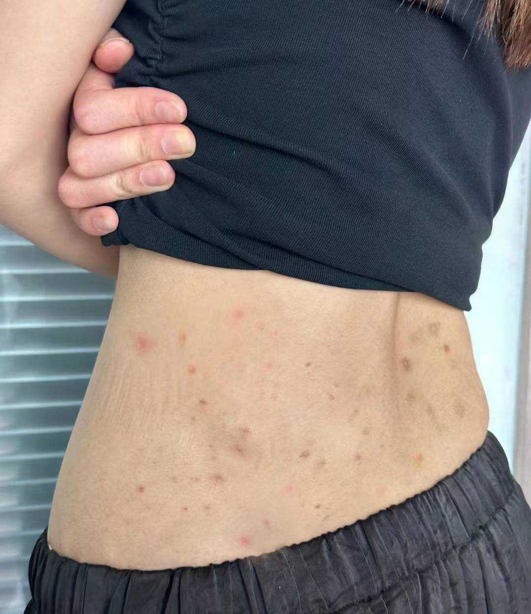 身上总是起红斑疱疹不见好,过来人居家自用的四个小妙招,一定不能错过