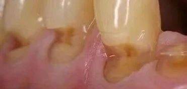 没有蛀牙却要补牙?钱塘牙科:可能是锲状缺损!_牙齿_治疗_症状