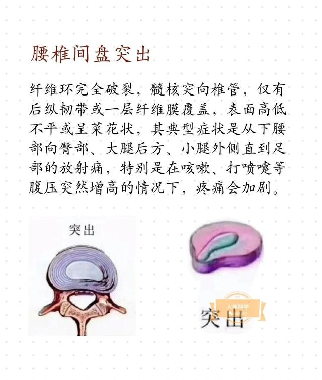 椎间盘膨出图片图解图片