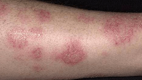 长沙皮肤科挂号一皮炎与湿疹有什么不同的区别?