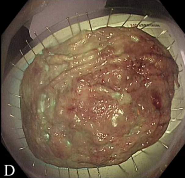 lst造成肠梗阻,肠镜下治愈,浙江省新华医院病例登上gie