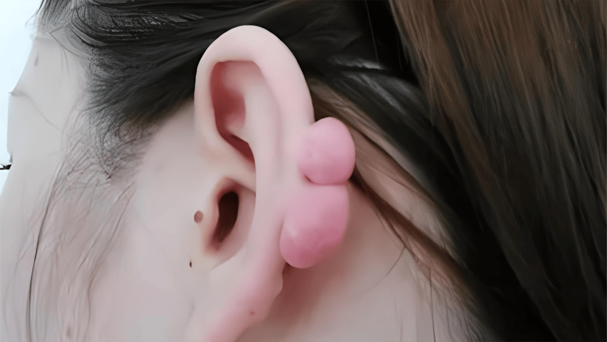 耳洞增生手术多少钱图片