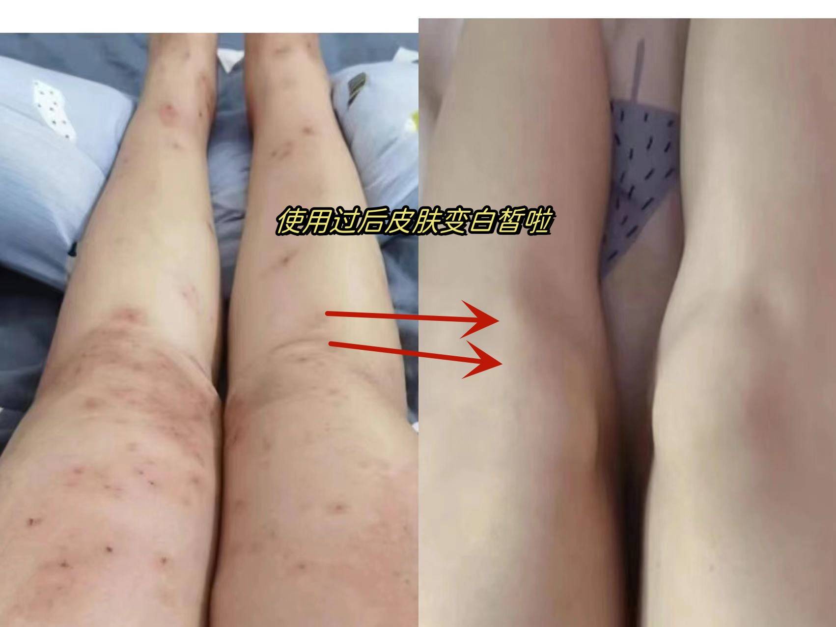 胳膊起疹总是痒痒坚持3步用对方法快速去除恢复光滑皮肤