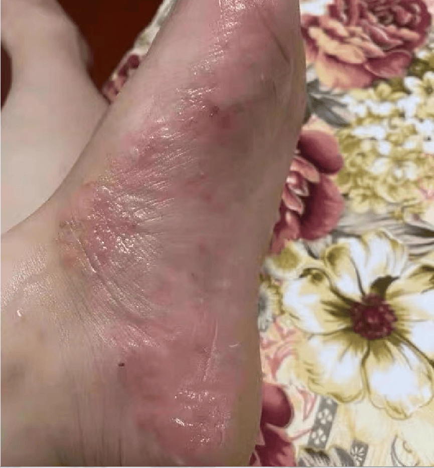 脚上遍布水泡还很痒学会这三个方法从此告别脚气