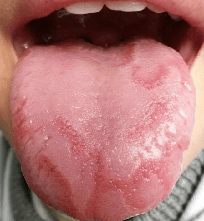 舌苔发黄的原因有哪些图片