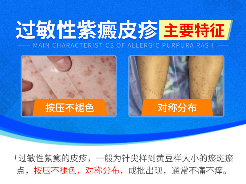 贵州过敏性紫癜怎么判断?成都西南中医医院
