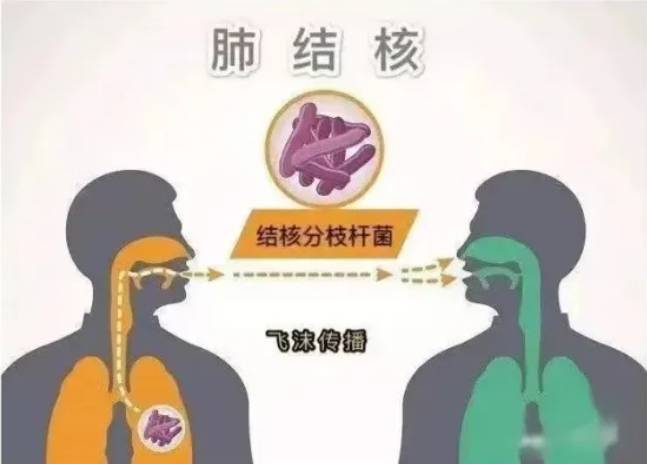 肺结核有什么症状图片