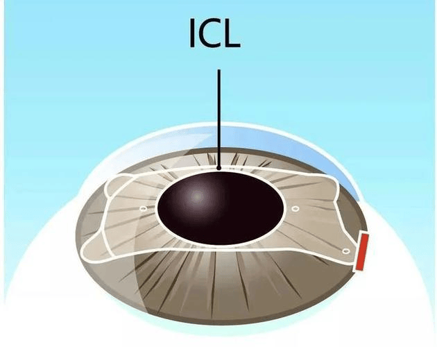 icl晶体长期放在眼里,到底安不安全?