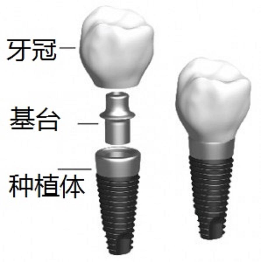 邢台种植牙专家为您详解:个性化基台和成品基台有什么不同?