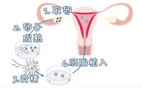 试管婴儿技术过程就是取出女性的卵子和男性的精子进行体外授精,形成