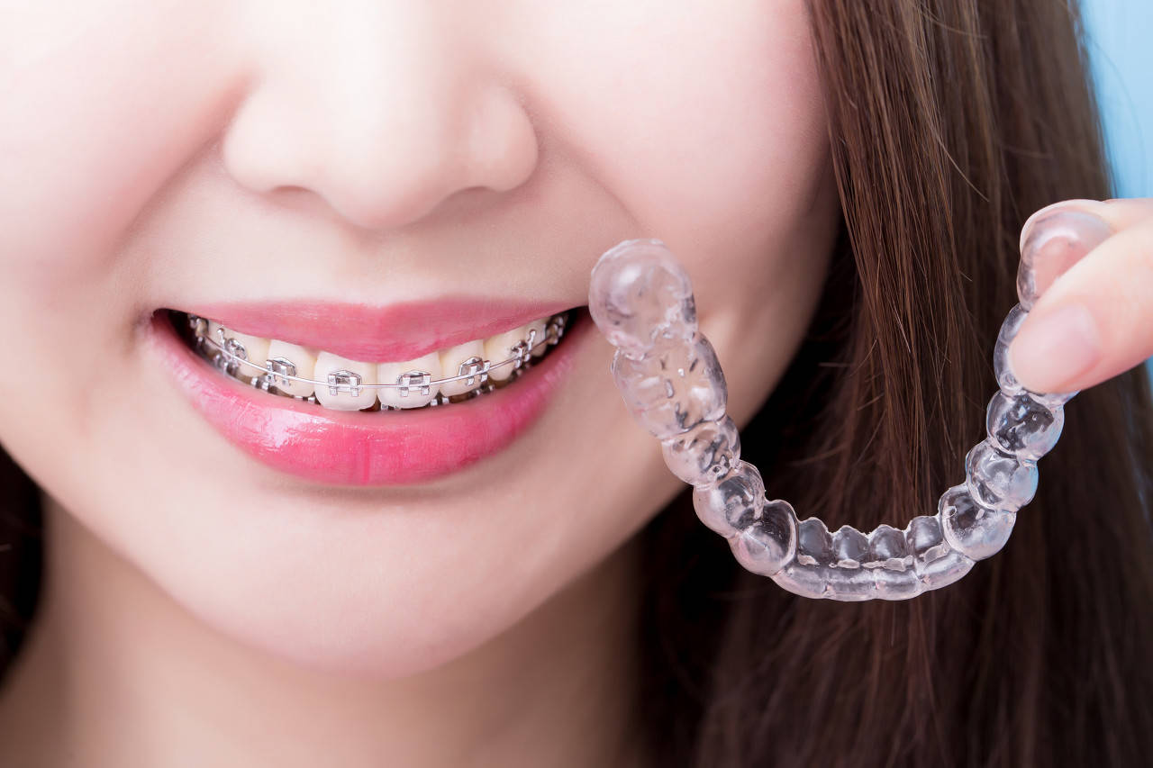 邢台正畸专家:矫正牙齿戴牙套多久可以看出效果呢?