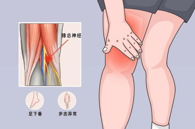 腓总神经走行解剖图图片