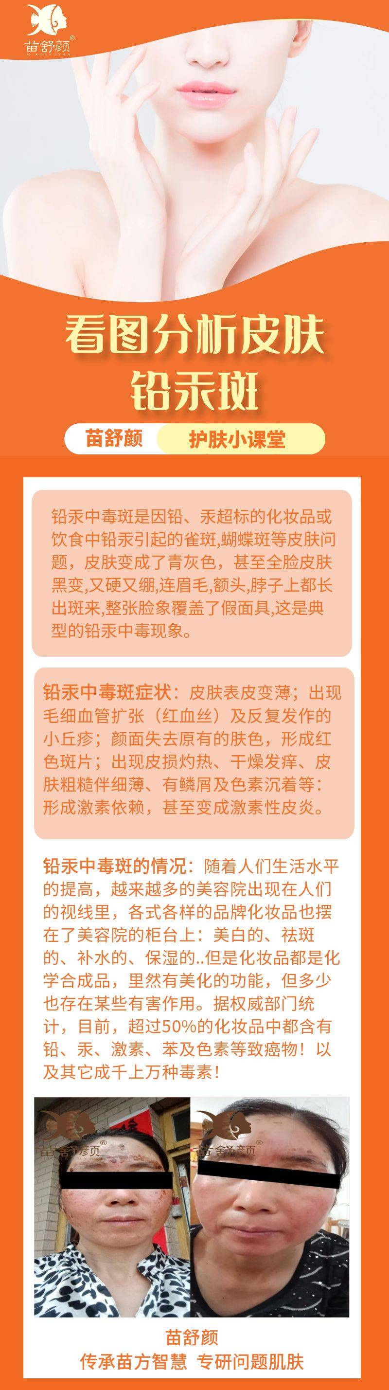 苗舒颜护肤小课堂·看图分析皮肤·铅汞斑