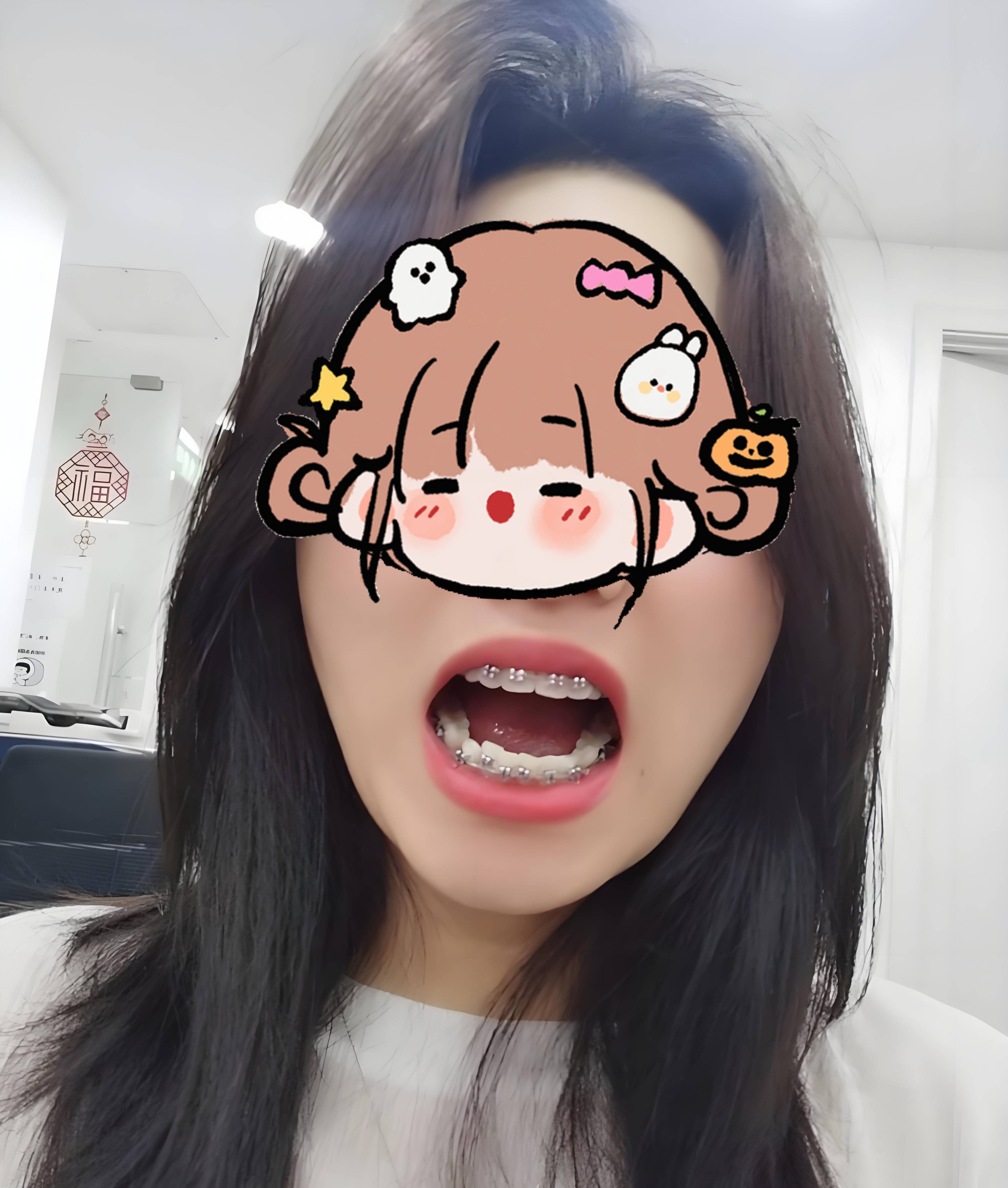 邢台牙齿矫正,两年戴牙套真实分享