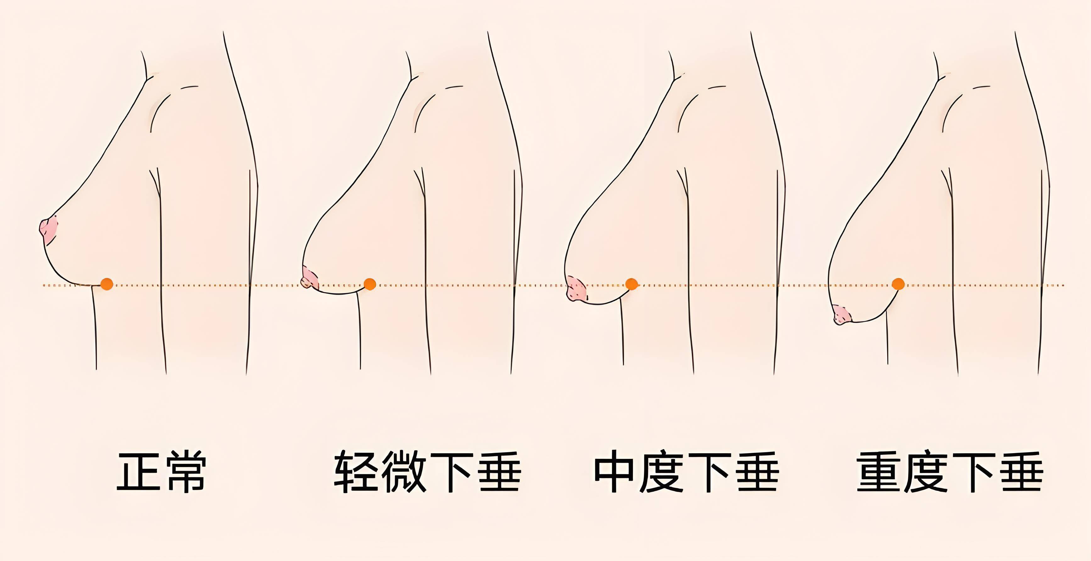 乳房悬韧带断裂图片图片