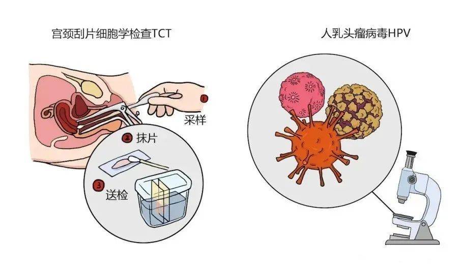 郑州新世纪医院hpv特诊中心:宫颈癌"三阶梯"诊断模式,你知道几个?